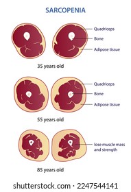 Infografía de la ilustración vectorial de sarcopenia aislada en fondo blanco. Sección cruzada de la pérdida de masa muscular y de fuerza en diferentes edades. Ilustración del concepto de anatomía y atención de la salud.