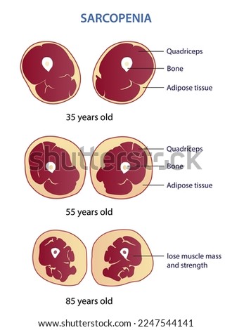 Infographic of sarcopenia vector illustration isolated on white background. Cross section of losing muscle mass and strength in different age. Anatomy and health care concept illustration.