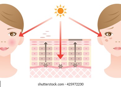 infographic skin illustration. diagram of turnover and skin spot formation