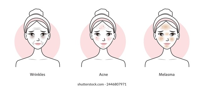 Infographic of skin problems set vector illustration. Cute women with wrinkles, aging, dark circles, acne, scar, melasma, hyperpigmentation and dark spots on faces. Skin care and beauty concept.