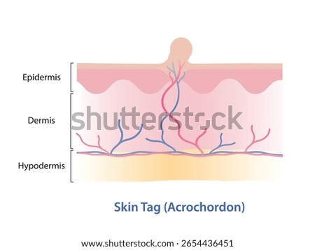 Infographic of skin tag vector illustration. Skin tag is small excess piece of skin that protrude from surface skin, often grow on neck, armpits, eyelid, under breast, groin, thigh and genital.