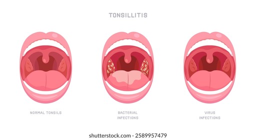 Infographic of sore throat due to bacteria and virus infection. Opened mouth showing of Tonsillitis or tonsil inflammation symptom. Concept of illness, health care, oral disease. Flat vector style.