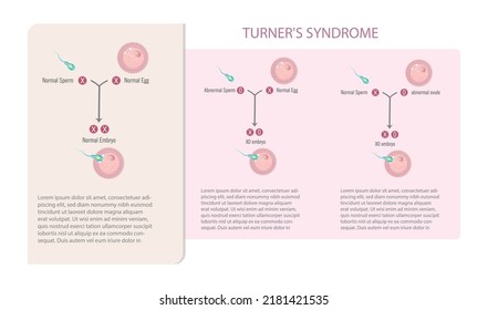 Infographic of sperm and egg with and without Turner's syndrome

