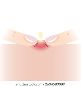 Infographic of squeezing pimple with two fingers on skin vector illustration isolated on white background. Pustule, inflammatory acne on skin, squeeze, popping pimple. Skin care and beauty concept.