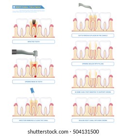 infographic stages of root canal treatment