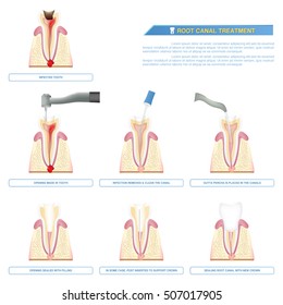 infographic  stages of  root canal treatment