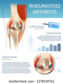 Infographic Treatment Method Rheumatoid Arthritis. 3d Banner Vector Illustration Anatomy Human Knee Joint with Diseases. Information Joint Treatment with Medicine Injection for Pain Relief