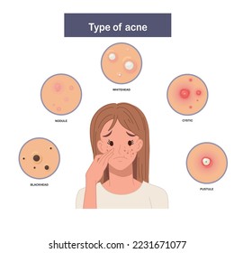 Infographic of Type of acne, sad and worried woman with acne. Flat vector illustration