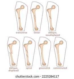 Infographic with types of fractures of the human femur. Medical poster, vector illustration