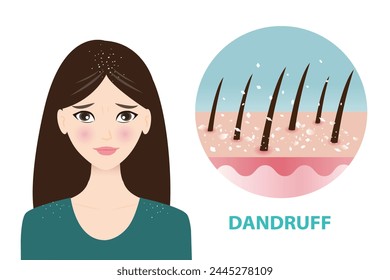 Infographic of woman and dandruff icon vector illustration. The woman is worried about white dry flakes on hair and shoulder. Icon of dandruff, scaly scalp in hair. Hair care and problem concept.