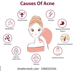 Infographics of acne. Causes of the disease, treatment. Beauty cartoon illustration