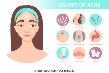 Infographics Acne Statistics Causes Disease Stock Vector (Royalty Free ...