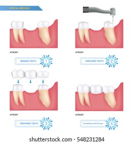 infographics dental bridge used to cover a missing tooth