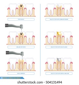 Infographics dental caries treatment and the different types of tooth fillings