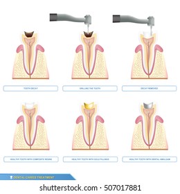 Infographics dental caries treatment and the different types of tooth fillings