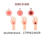 infographics of different degrees of burn. medical poster depicting wounds of the skin of the hands, red epidermis symptom. first aid for sites, apps. flat color sign isolated on white background.