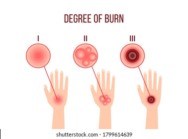 infographics different degrees burn  medical poster depicting wounds the skin the hands  red epidermis symptom  first aid for sites  apps  flat color sign isolated white background 