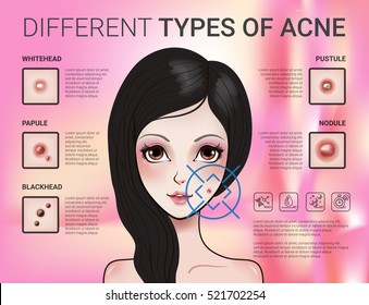 Infographics Of Different Type Of Acne. Vector Illustration With Skin Problems.