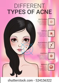 Infographics of different type of acne. Vector Illustration with skin problems.