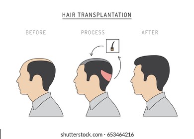 Infographics on the subject of hair transplantation on the example of a man with a picture of the result of transplantation before and after. Vector image of a patient isolated on white background