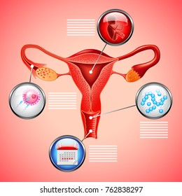 infographics with uterus and gynecological objects in circles on red background vector