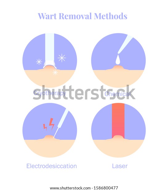 Infographics Wart Removal Methods Cryotherapy Electrodesiccation 스톡 벡터로열티 프리 1586800477 