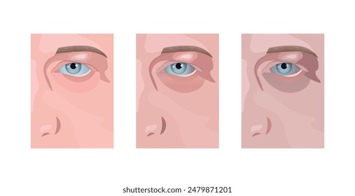 Información sobre enfermedades oculares. Deterioro de la conciencia, deterioro de la visión. El ojo ve mal. Concepto de oftalmología. Cita con un médico. EPS10
