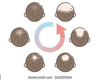 Information chart of hair loss stages types of baldness illustrated on male head vector.