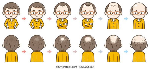 Information chart of hair loss stages types of baldness illustrated on male head vector.