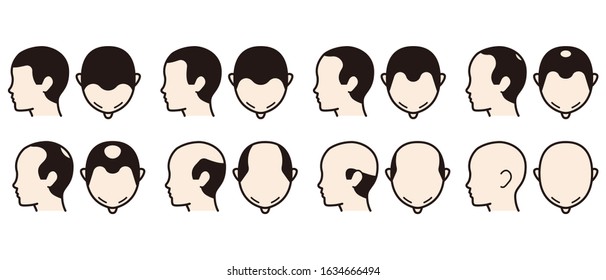 Information chart of hair loss stages and types of baldness illustrated on a male head.