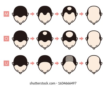 Information chart of hair loss stages and types of baldness illustrated on a male head.