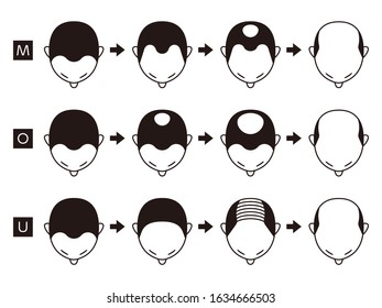 Information chart of hair loss stages and types of baldness illustrated on a male head.