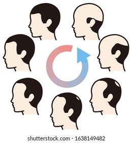 Information chart of hair loss stages and types of baldness illustrated on a male head.