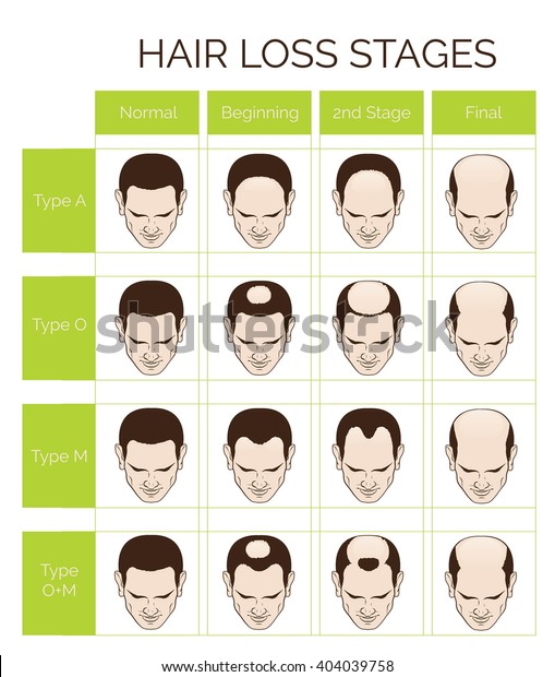 Information Chart Hair Loss Stages Types Stock Vector Royalty