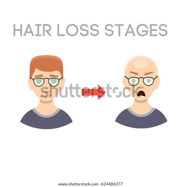 Information Chart Hair Loss Stages Types Stock Vector Royalty