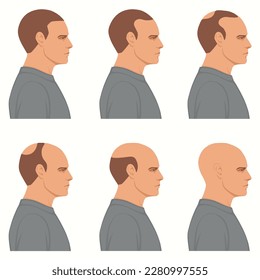 Information chart showing stages of hair loss for men. Bolding head from full hair cover to a final stage of baldness.