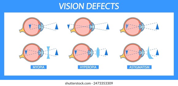 Informative Chart Detailing Myopia, Hyperopia, And Astigmatism In Eye Anatomy. Vector Visual Comparison