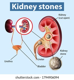 Informative illustration of kidney stones illustration