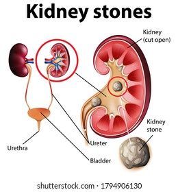 Informative illustration of kidney stones illustration