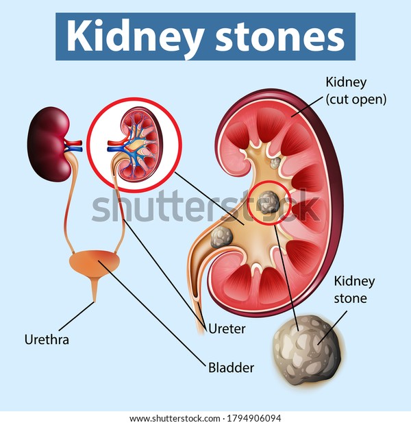 Informative\
illustration of kidney stones\
illustration