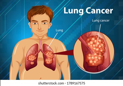 Informative illustration of lung cancer illustration
