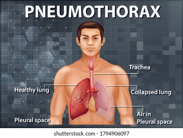 Informative Illustration von Pneumothorax