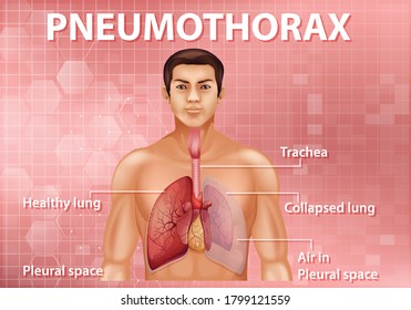 Informative illustration of Pneumothorax illustration