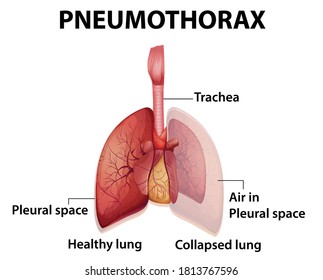 Ilustración informativa de Pneumothorax