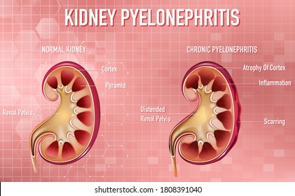 Informative illustration of Pyelonephritis illustration