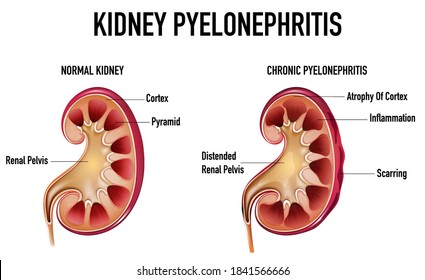 Informative illustration of Pyelonephritis illustration