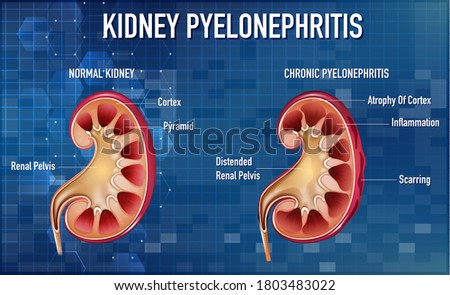 Informative illustration of Pyelonephritis illustration