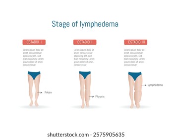 Informative illustration showing the three stages of lymphedema, from initial fluid accumulation to advanced fibrosis, accompanied by descriptive anatomical graphics.