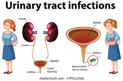Informative illustration of urinary tract infections illustration