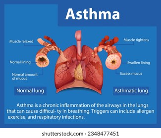 An informative infographic comparing normal and asthma lungs